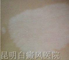 白癜风的发病原因