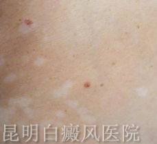 白癜风的早期症状有哪些