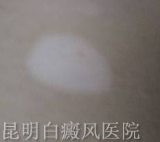 白癜风是什么样的症状