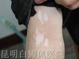 白癜风应该吃哪些