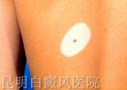 白癜风怎么治疗