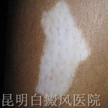 白癜风可以治好吗