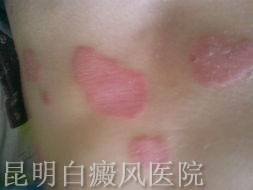白癜风应该怎样治疗