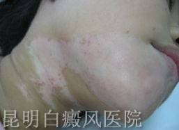 白癜风怎样治疗有效