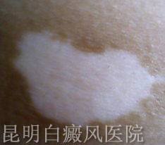 白癜风要怎样治疗呢