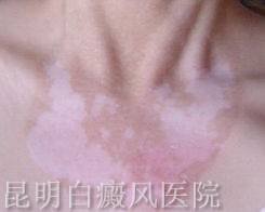 白癜风能否治好