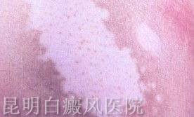 如何治疗老年白癜风