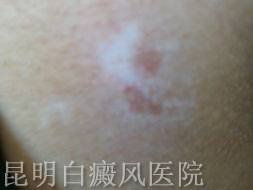 白癜风要如何治疗呢