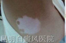 白癜风怎么办