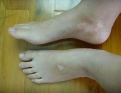 白癜风有哪些症状表现