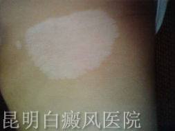 治疗白癜风要注意哪些事
