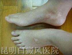 得了白癜风要如何治疗