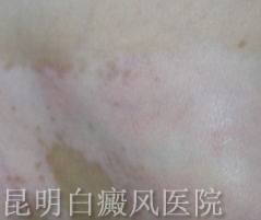 治疗白癜风用什么方法好