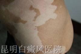 白癜风康复需要多久