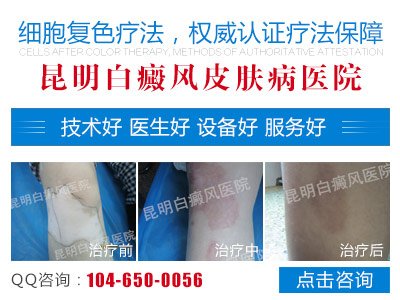 昆明白癜风医院那家好
