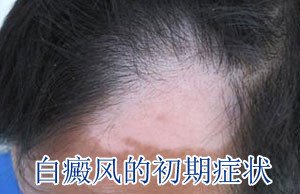 白癜风发病症状有什么 白癜风发病症状有什么