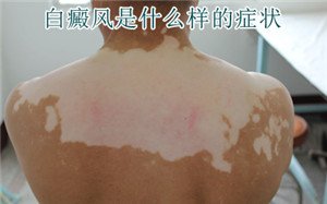 常见的白癜风症状有哪些 常见的白癜风症状有哪些