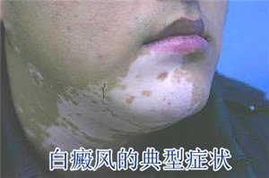脸上出现白癜风怎么办 脸上出现白癜风怎么办