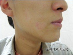 白癜风早期什么症状 白癜风早期什么症状