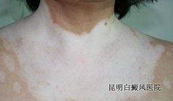 加重白癜风病情的原因 加重白癜风病情的原因