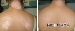 昆明白癜风哪家医院较好 昆明白癜风哪家医院较好