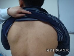 白癜风护理方法有哪些 白癜风护理方法有哪些