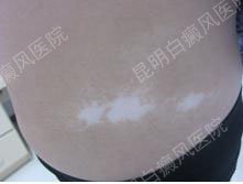 26岁女性腹部患白癜风3年
