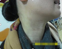 40岁女性颈部白癜风10余年