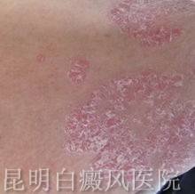 白癜风应该怎么预防