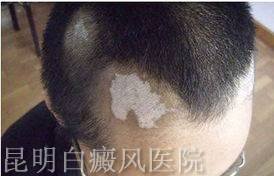 如何预防头部白癜风