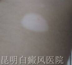 白癜风有没有传染性