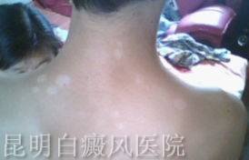 白癜风传染别人吗