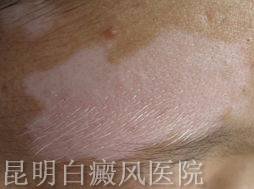 白癜风的常识有哪些