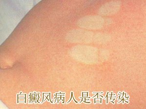 治疗白癜风的特效药