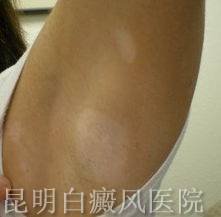 白癜风病应注意的事项