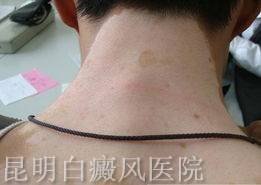 白癜风复发的表现