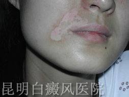 引发面部白癜风的原因