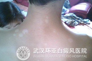 怎样诊断白癜风比较有用