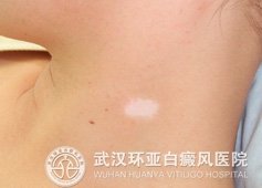 引起白癜风的发病原因