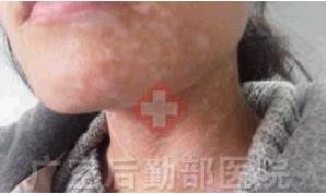 两个月康复颈部进展期白癜风