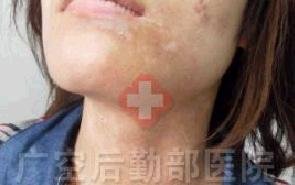 两个月康复颈部进展期白癜风