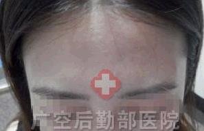 两个月康复额头进展期白癜风