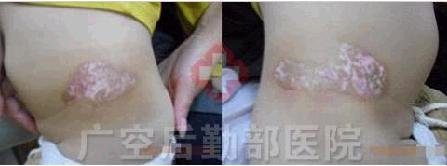 3个月康复胯部白癜风患儿