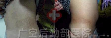 3个月康复胯部白癜风患儿