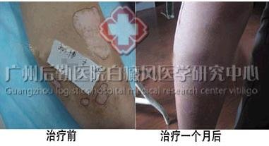 在校学生稳定期白癜风
