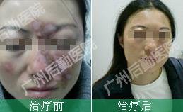 5年白癜风深陷自卑中