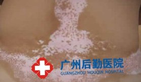 后期白癜风有什么症状