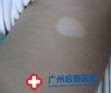 什么是白癜风呢
