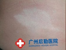 白癜风患者如何养身