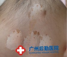 白癜风诊断的并发症是什么